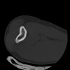 SPORK, NICO - 22.03.1976 - 02.08.2022 - CT obere Extremität - 17:59:38